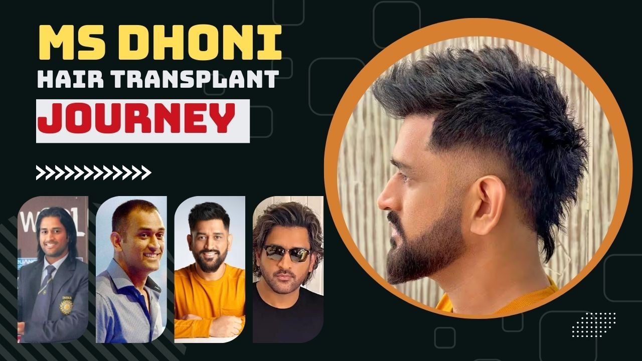 MS Dhoni’s Hair Transplant Journey Explained by Dr. Kiran Chotaliya 