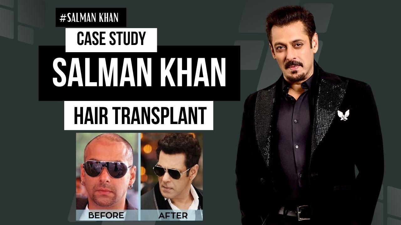 Salman Khan’s Hair Transplant Journey Explained by Dr. Kiran Chotaliya | Celebrity Hair Transplant