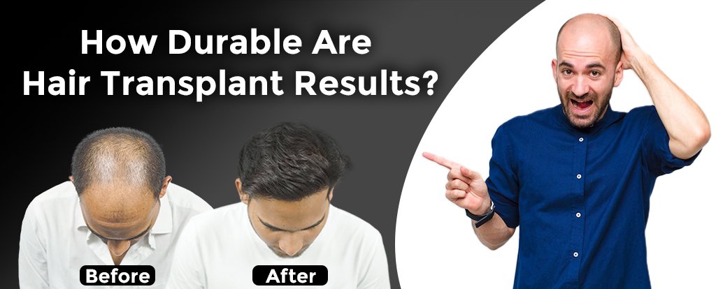 How-Durable-Are-Hair-Transplant-Results