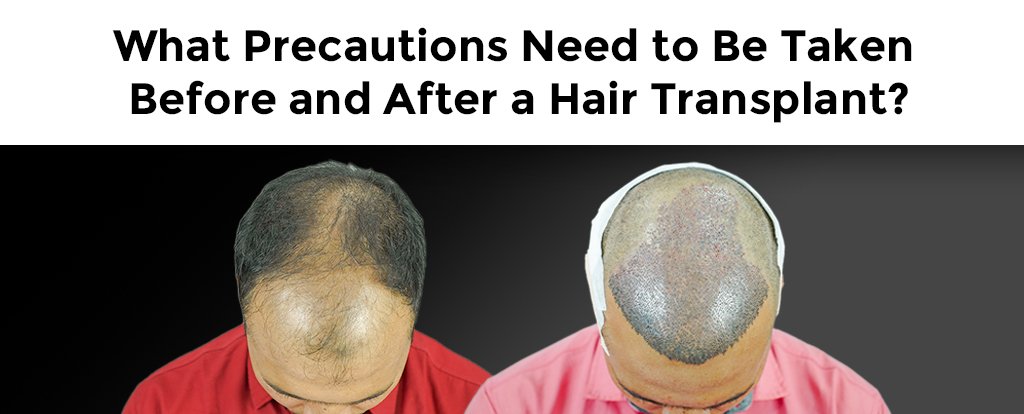 What-Precautions-Need-to-Be-Taken-Before-and-After-a-Hair-Transplant.