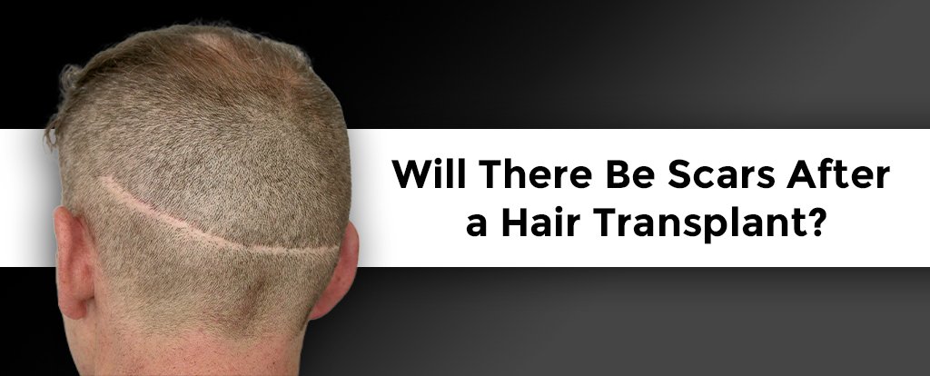 Will-There-Be-Scars-After-a-Hair-Transplant