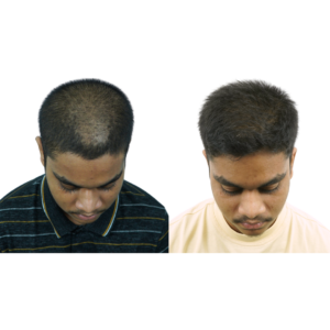 male hair transplant before and after