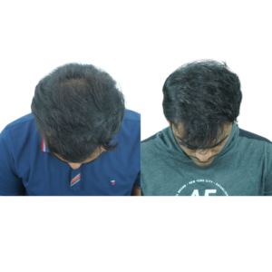 male hair transplant before and after