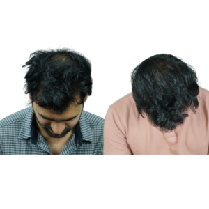 male hair transplant before and after