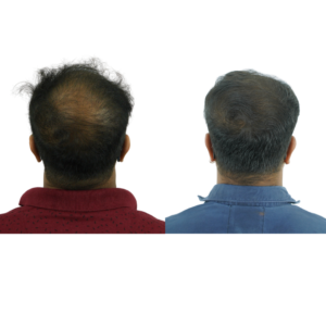 male hair transplant before and after