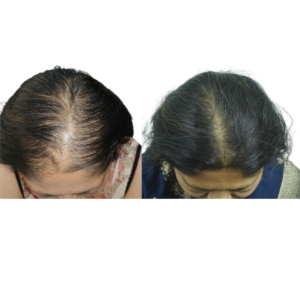 female hair transplant before and after