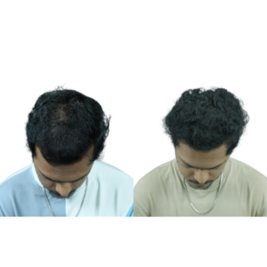 male hair transplant before and after