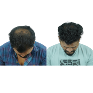 male hair transplant before and after