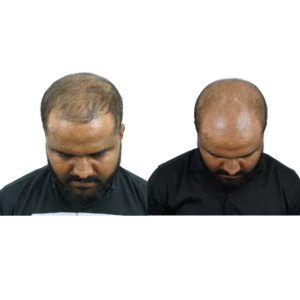 male hair transplant before and after