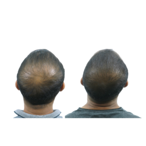 male hair transplant before and after