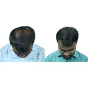 male hair transplant before and after