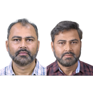 male hair transplant before and after