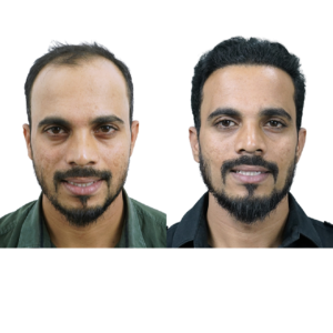male hair transplant before and after