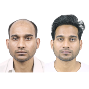 male hair transplant before and after