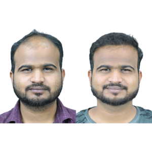 male hair transplant before and after
