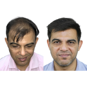 male hair transplant before and after