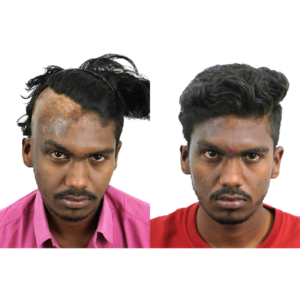 male hair transplant before and after