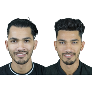 male hair transplant before and after