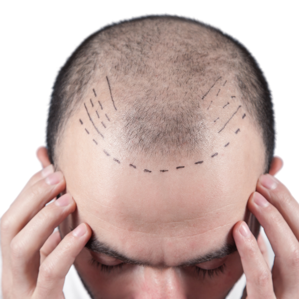 what is male hair transplant treatment