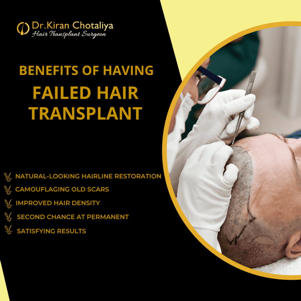 Benefits of Failed Hair Transplant