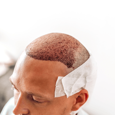 what is Failed Hair Transplant