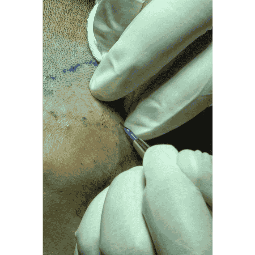 Local Anesthesia 