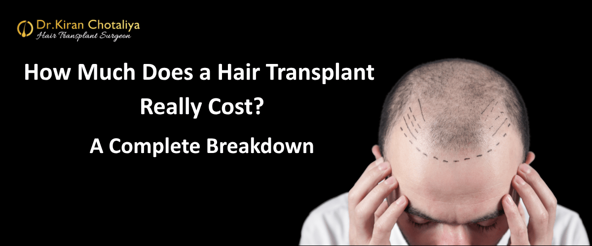 How Much Does a Hair Transplant Really Cost? A Complete Breakdown