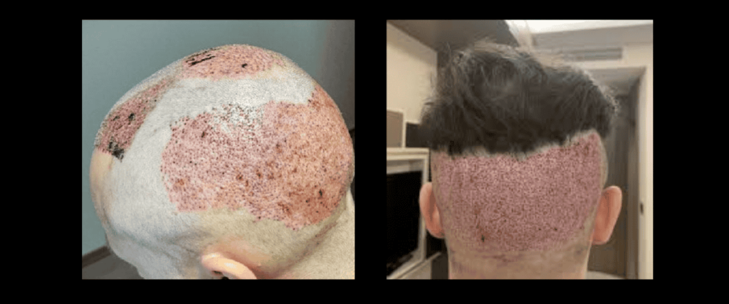 Risk of Hair Transplant