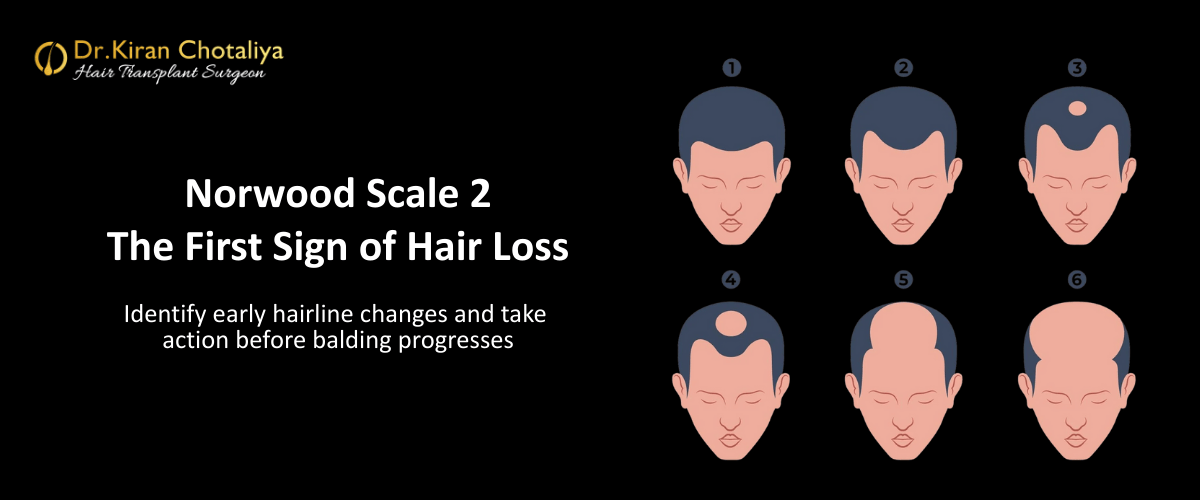 How to Stop Balding at the Earliest Stage: A Complete Guide to Norwood Scale 2