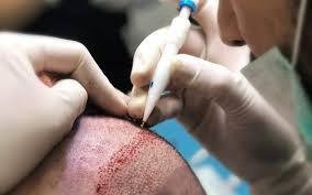 Channel Opening in hair tranplant