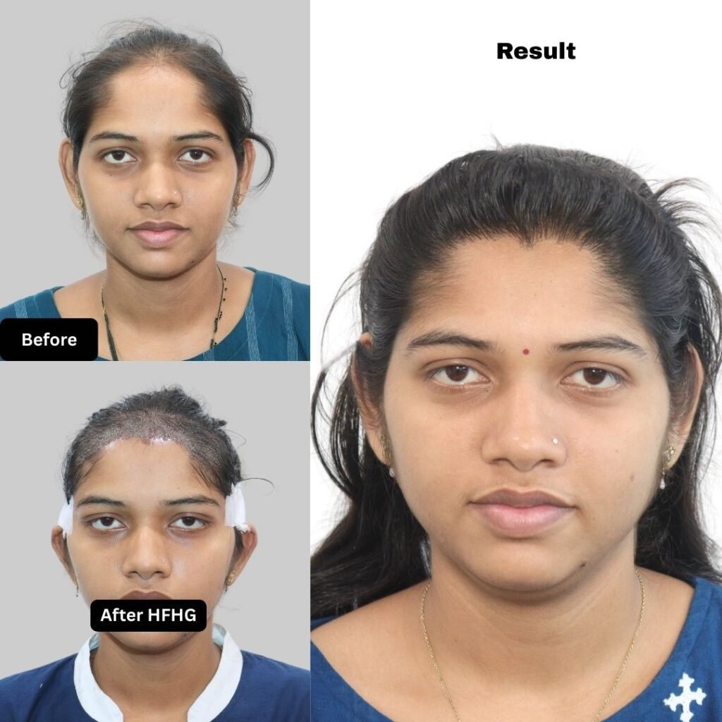 Female Hair Transplant