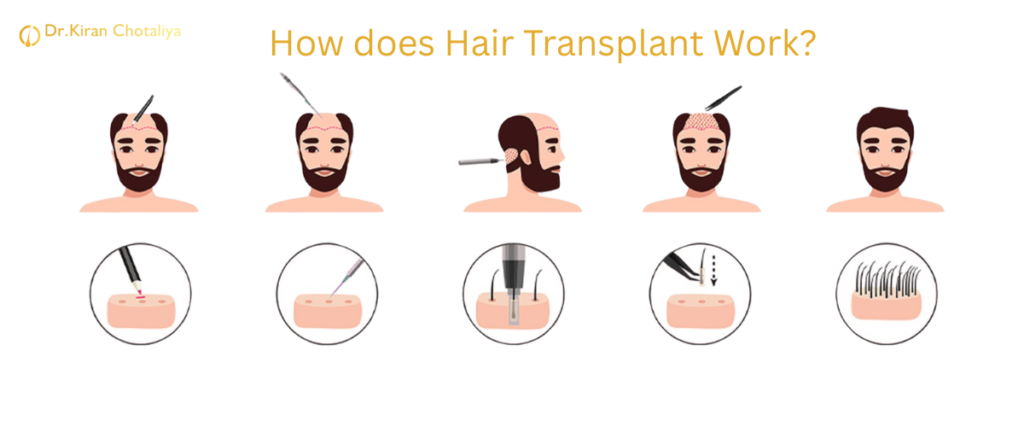 Hair Transplant Clinic in Pune