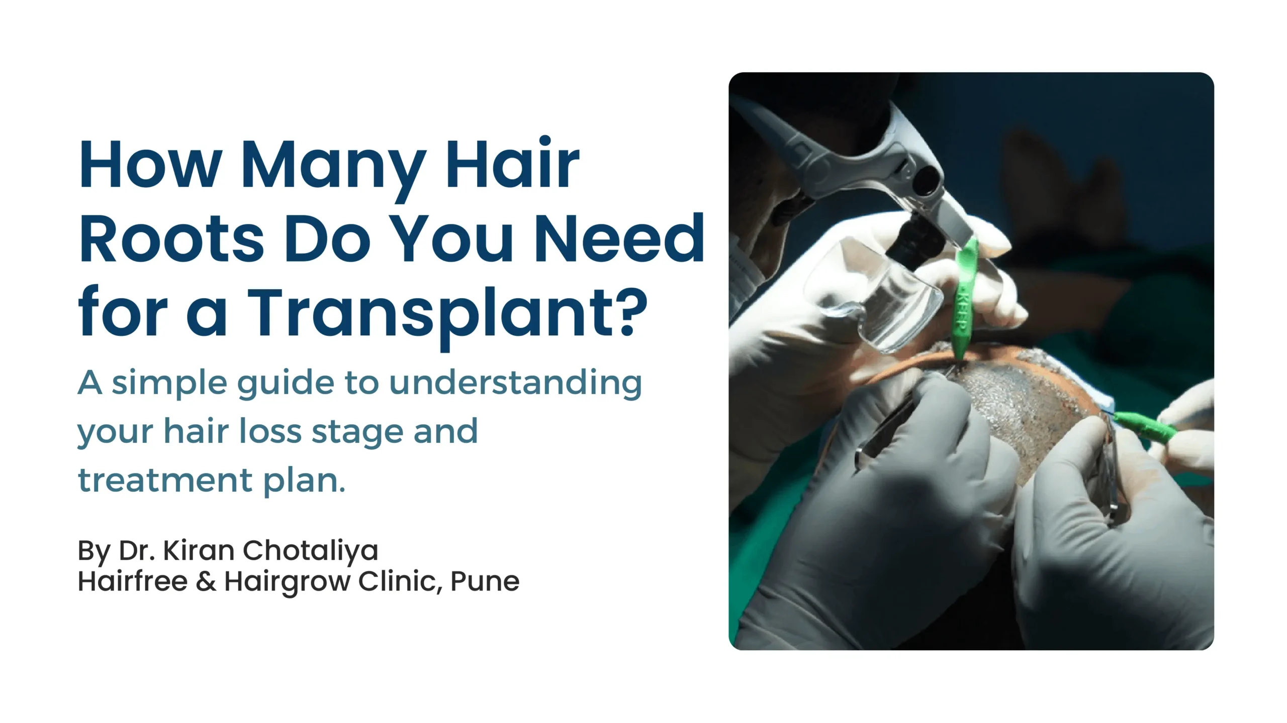 How Many Grafts Are Needed for Hair Transplant