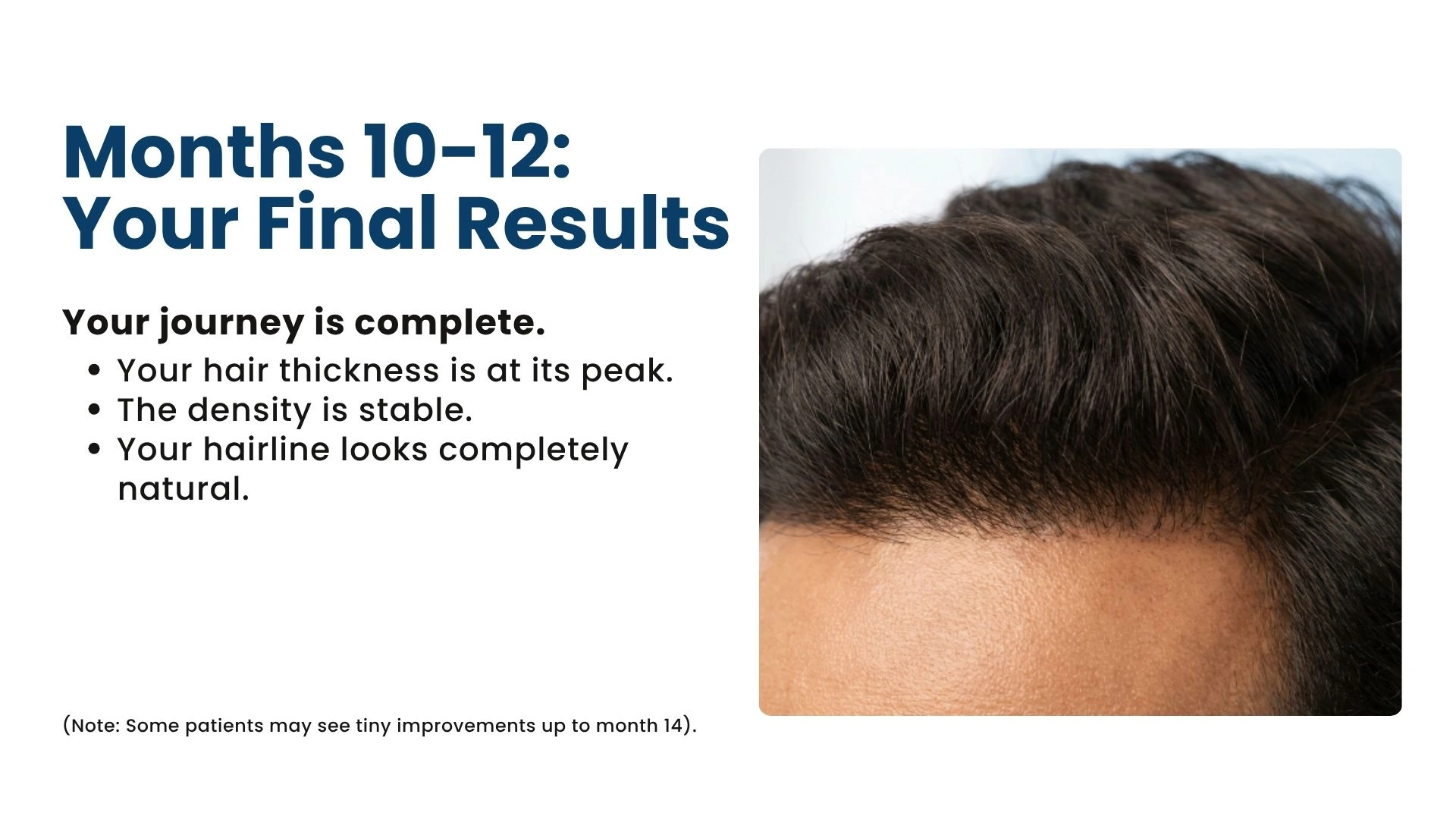 Hair transplant growth stages after surgery in pune, dr. kiran chotaliya clinic, Hair Transplant surgeon In Pune