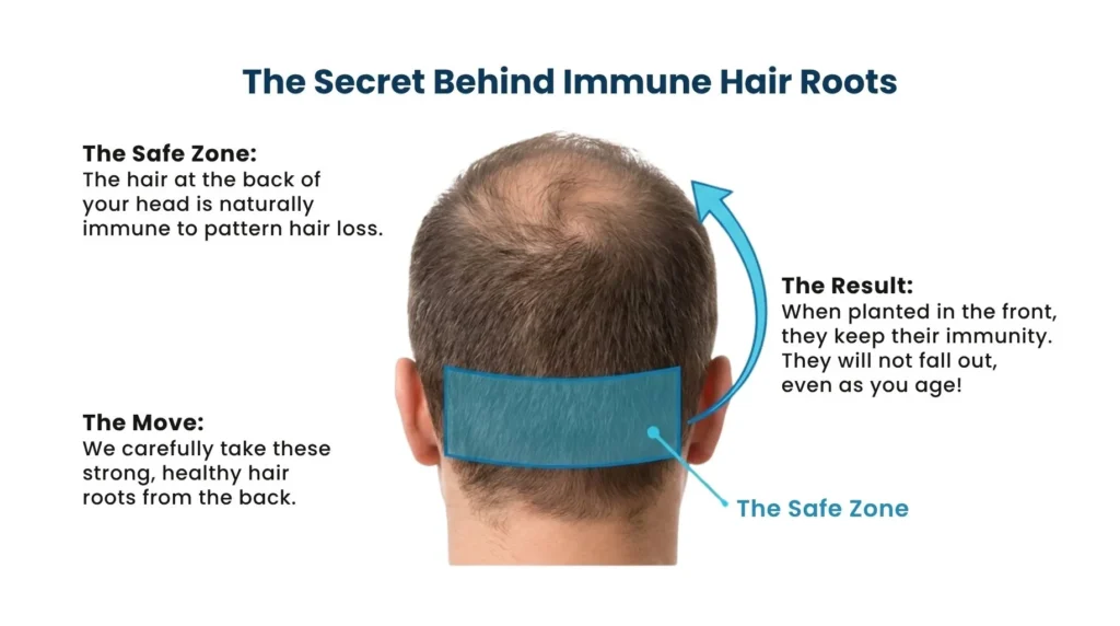 What is donor dominance in hair transplant Pune clinic Hair TrIansplant In Pune, dr. kiran chotaliya clinic