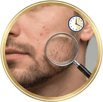 Beard and Moustache Hair Transplant Showing Minimal Downtime and Virtually No Visible Scarring