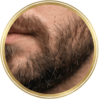 Natural Hair Growth Result After Beard Hair Transplant Showing Dense Facial Hair