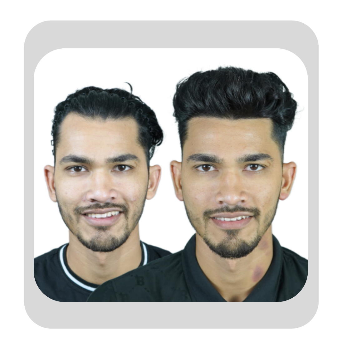 Male Hair Transplant -21