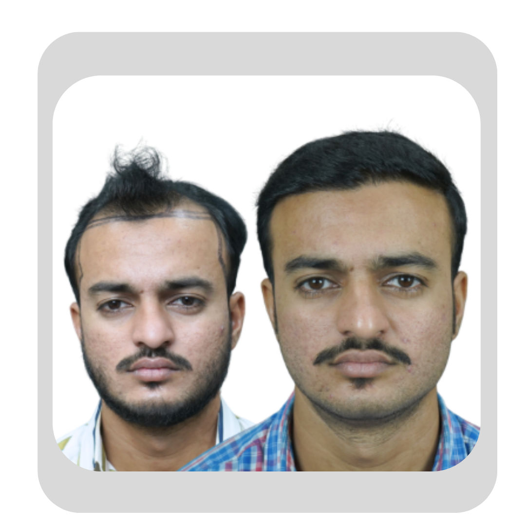 Male Hair Transplant -23