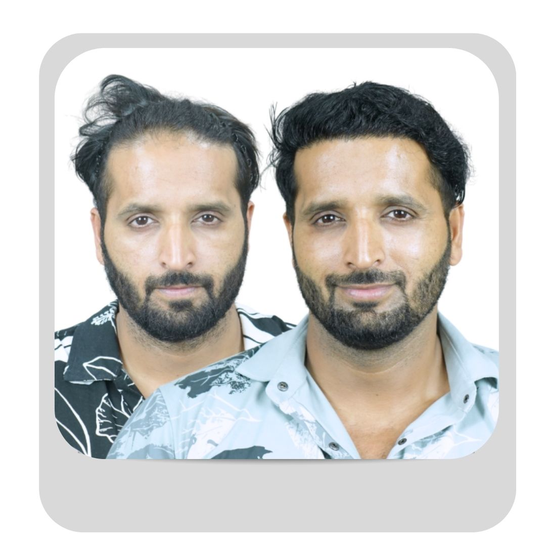 Male Hair Transplant -24