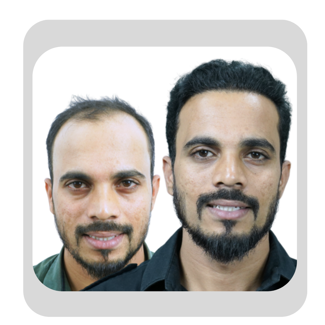 Male Hair Transplant -25