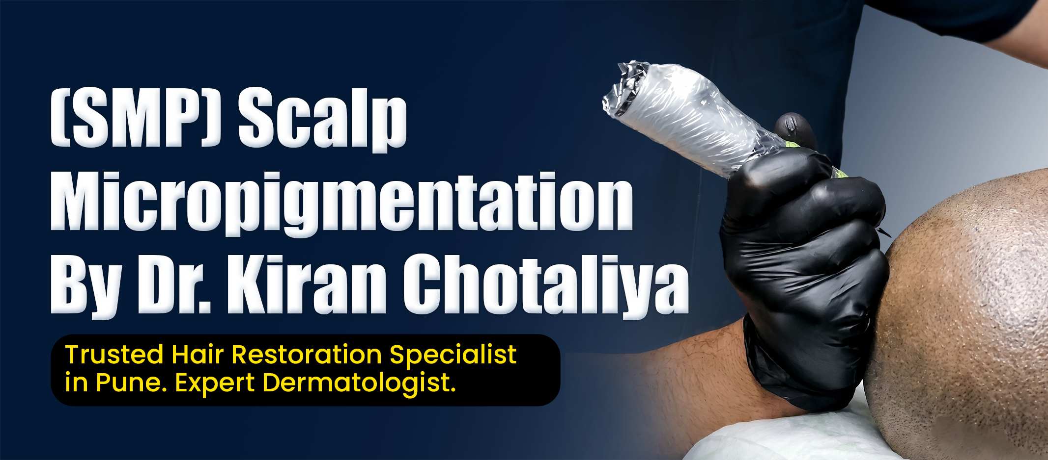 Scalp Micropigmentation in Pune Procedure Showing SMP Pigment Application for Hair Loss Concealment