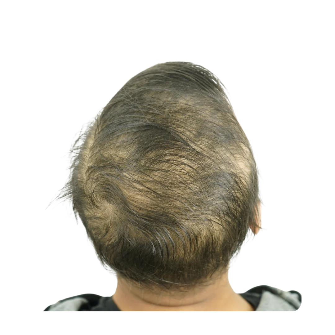 Back view diffuse thinning. Hair transplant Pune candidate seeking high-density restoration for thinning hair
