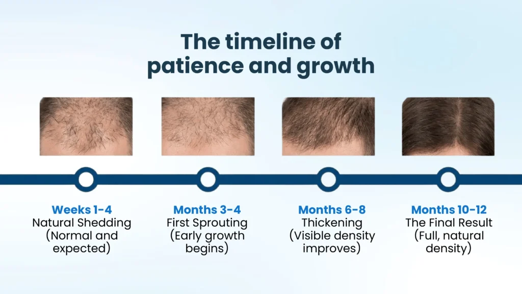 Hair transplant growth timeline showing gradual hair regrowth and final results after a hair transplant in Pune