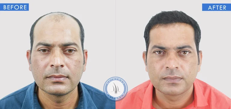 Best Hair Transplant Surgeon in Pune showing before and after hair transplant results for severe hair loss