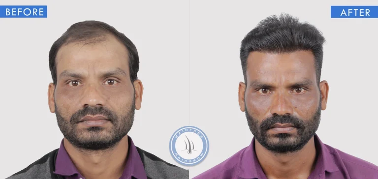 Best Hair Transplant Surgeon in Pune showcasing before and after hair transplant transformation results