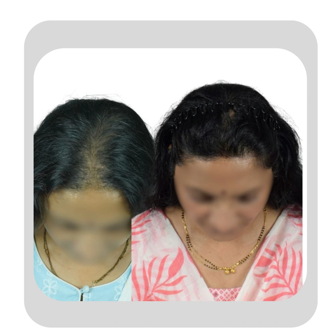 Comparison of female pattern hair loss before and after a hair transplant procedure at Dr. Kiran Chotaliya's clinic in Pune.
