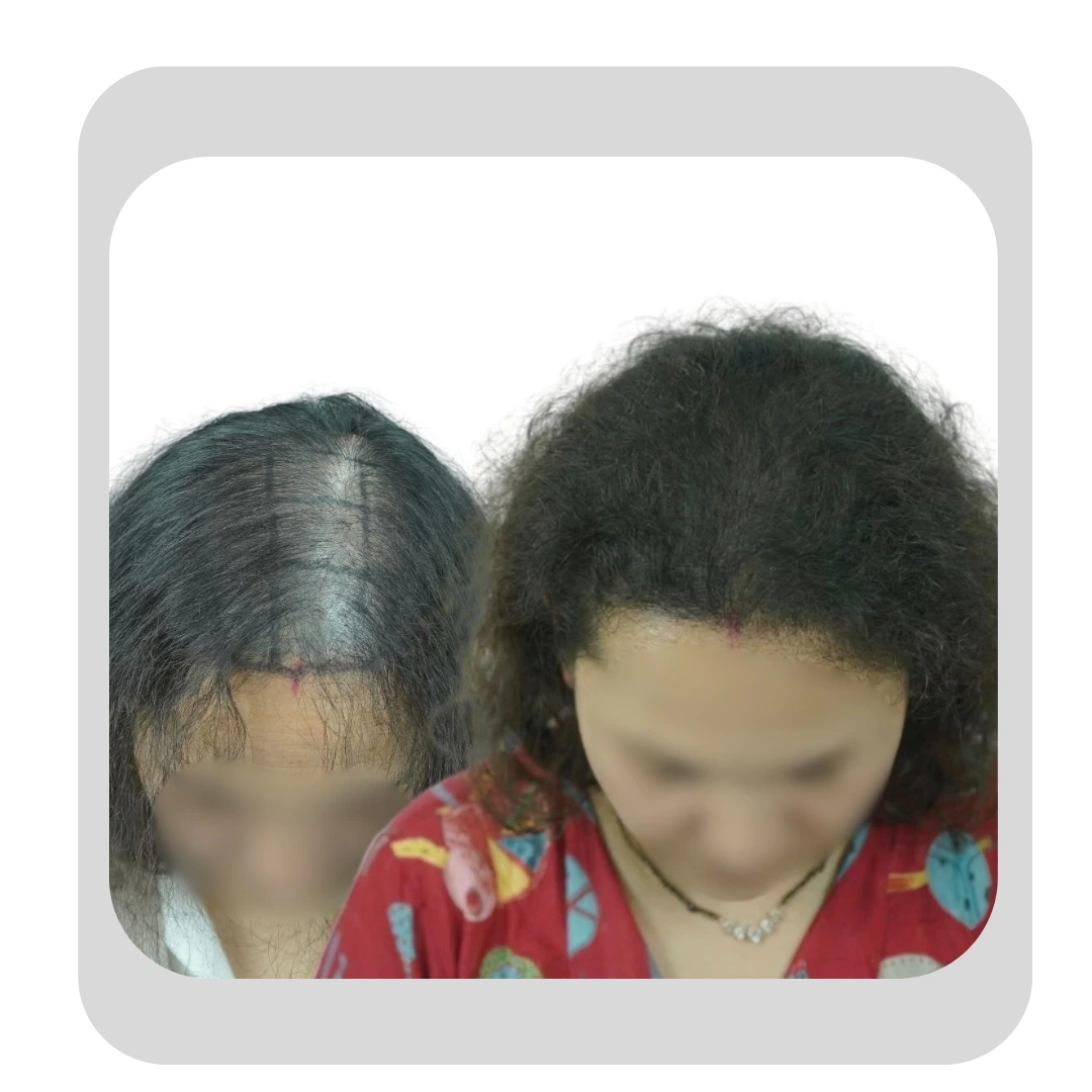 Before and after of female hair transplant in Pune fixing a widening part and thinning crown, by Dr. Kiran Chotaliya.