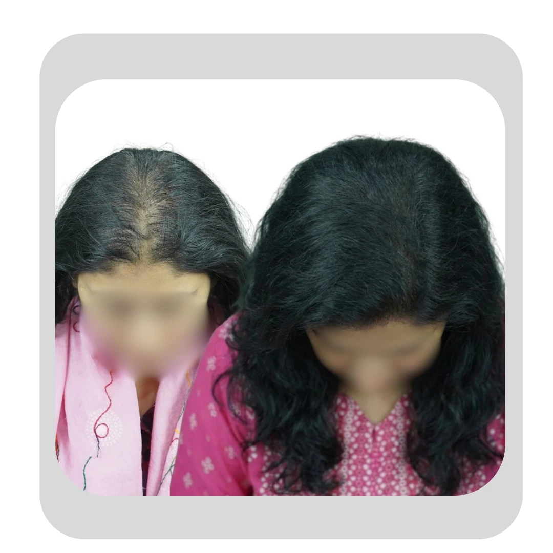 Before and after of a female hair transplant in Pune showing restoration of a thinning crown and increased hair density.