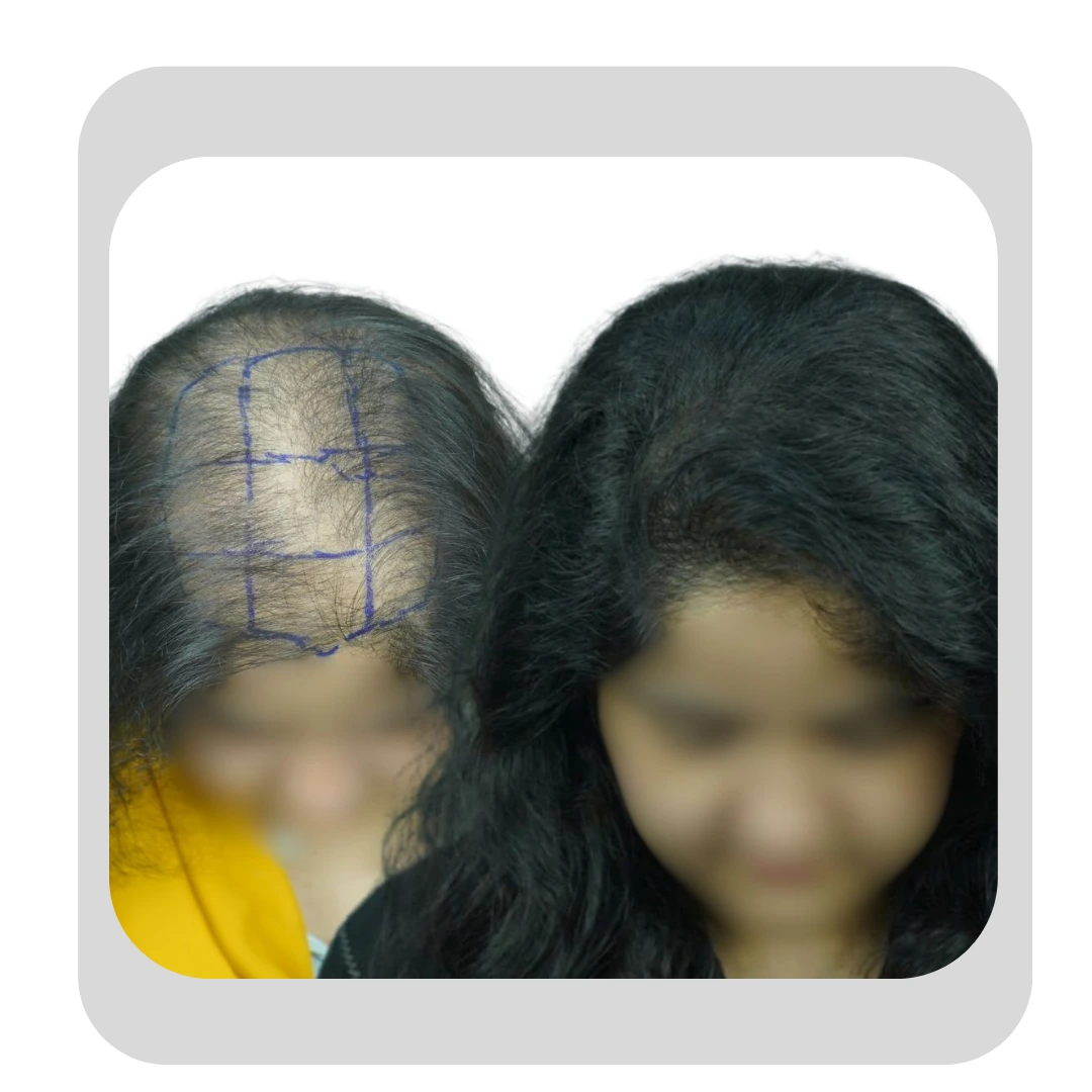 Before and after results of a female hair transplant in Pune showing increased crown hair density at Dr. Kiran Chotaliya's clinic.